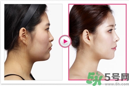 玻尿酸隆鼻的缺點(diǎn)是什么？玻尿酸隆鼻的優(yōu)點(diǎn)有哪些？