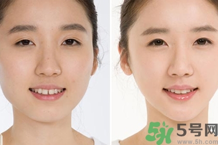 玻尿酸隆鼻的缺點(diǎn)是什么？玻尿酸隆鼻的優(yōu)點(diǎn)有哪些？