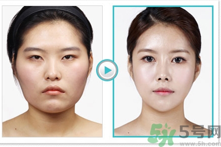 玻尿酸隆鼻和手術(shù)隆鼻的區(qū)別是什么？