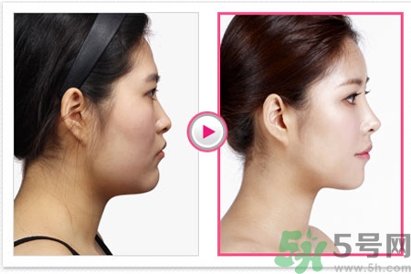 玻尿酸隆鼻和手術(shù)隆鼻的區(qū)別是什么？