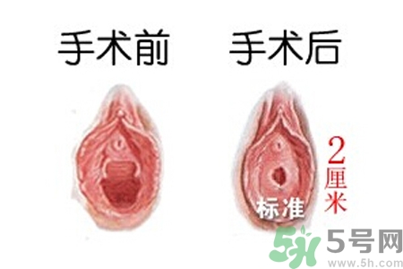 處女膜修補術(shù)效果怎么樣？處女膜修復手術(shù)有風險嗎？