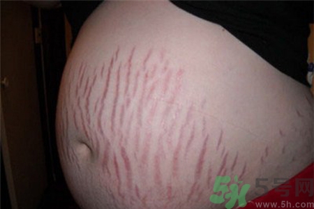 妊娠紋癢是怎么回事？妊娠紋癢怎么辦？