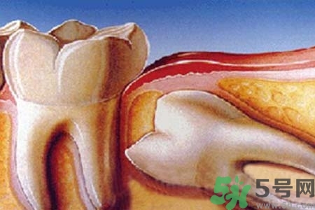智齒橫著長(zhǎng)怎么辦？智齒橫著長(zhǎng)一定要拔了嗎？