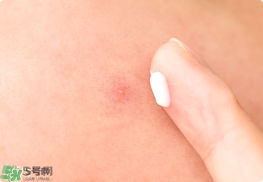 獅王祛痘膏怎么樣？獅王祛痘好用嗎？