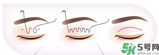 雙眼皮手術(shù)哪種最好？割雙眼皮后注意些什么？