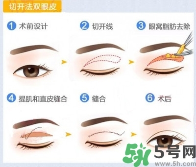 雙眼皮手術(shù)哪種最好？割雙眼皮后注意些什么？