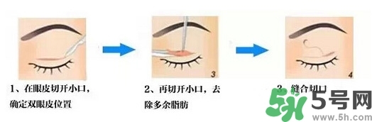 雙眼皮手術(shù)哪種最好？割雙眼皮后注意些什么？