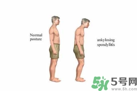 僵直性脊椎炎的癥狀有哪些？怎樣預(yù)防僵直性脊椎炎？
