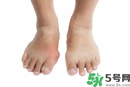 引發(fā)痛風(fēng)的原因是什么？痛風(fēng)病人飲食需注意什么好？