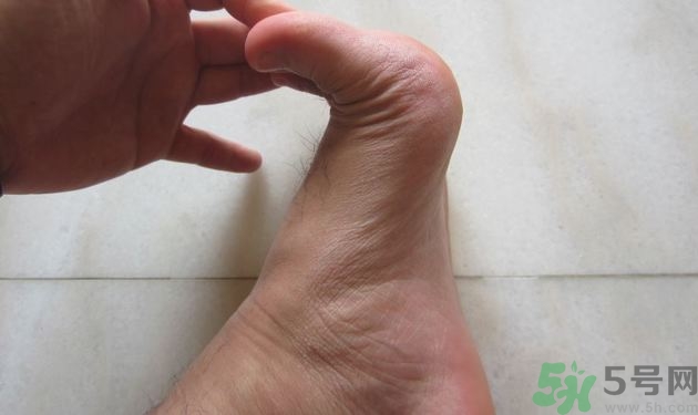 腳拇指外翻遺傳嗎？腳拇指外翻怎么矯正？