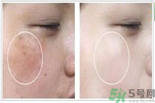 曬斑可以自己消退嗎？曬斑可以用激光去除嗎？