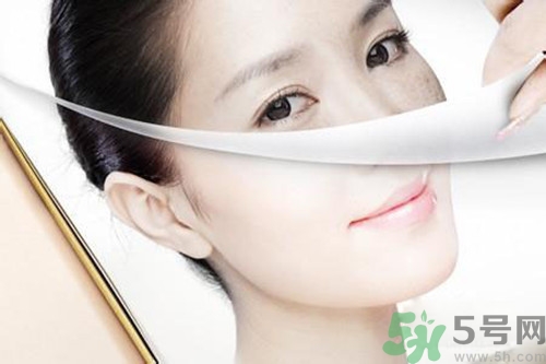 曬斑可以自己消退嗎？曬斑可以用激光去除嗎？