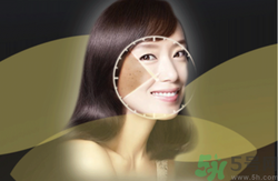 曬斑可以自己消退嗎？曬斑可以用激光去除嗎？