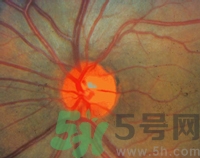 青光眼可以治愈嗎？青光眼怎樣治療？