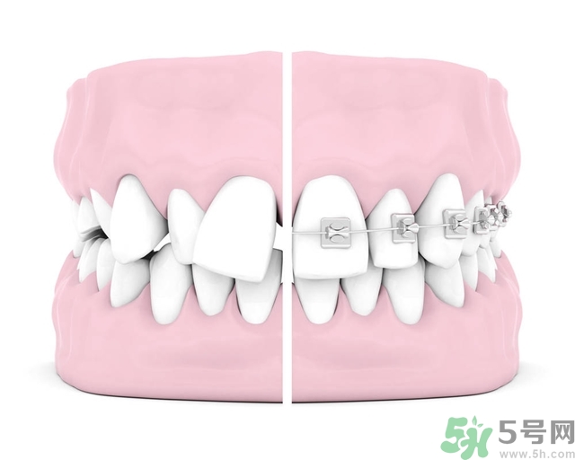 牙齒橫著長(zhǎng)怎么辦？智齒橫著長(zhǎng)一定要拔嗎？