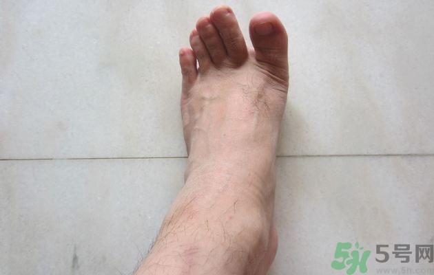 腳拇指外翻遺傳嗎？腳拇指外翻怎么矯正？