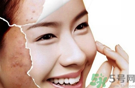 玻尿酸可以祛痘嗎?玻尿酸祛痘效果怎么樣? 玻尿酸可以祛痘嗎?玻尿酸祛痘效果怎么樣?