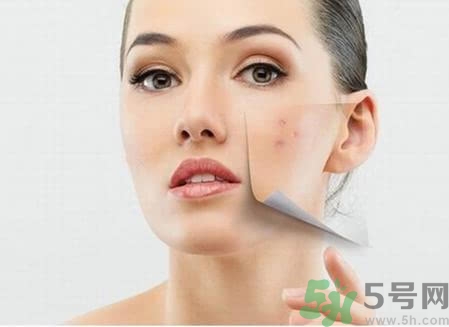 玻尿酸可以祛痘嗎?玻尿酸祛痘效果怎么樣? 玻尿酸可以祛痘嗎?玻尿酸祛痘效果怎么樣?