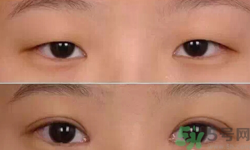 天生腫眼泡怎么消除？天生腫眼泡怎么辦？