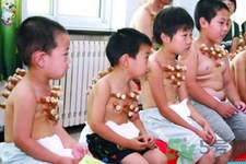 小孩可以拔罐嗎？寶寶能拔火罐嗎？