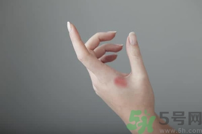 手被燙紅了怎么辦？手被燙了怎么止痛？