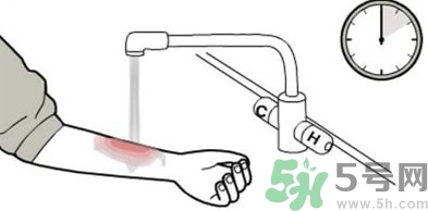 手被燙紅了怎么辦？手被燙了怎么止痛？