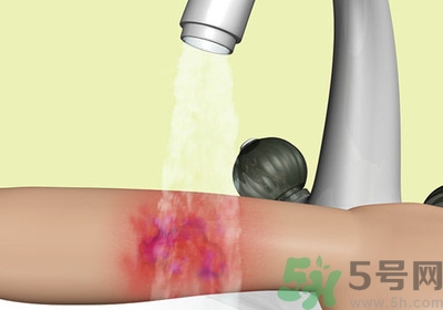 手被燙紅了怎么辦？手被燙了怎么止痛？