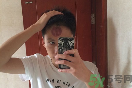 頭痛可以在額頭上拔火罐嗎？額頭上拔火罐有什么好處？