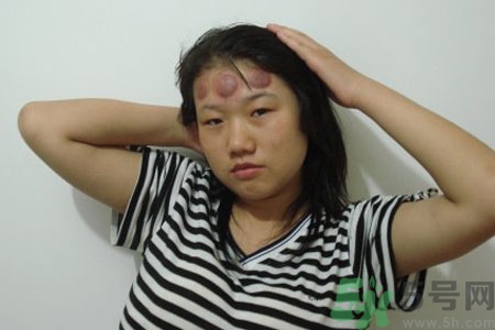 頭痛可以在額頭上拔火罐嗎？額頭上拔火罐有什么好處？