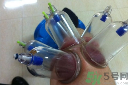 膝蓋能拔罐嗎？膝蓋疼可以拔罐嗎？