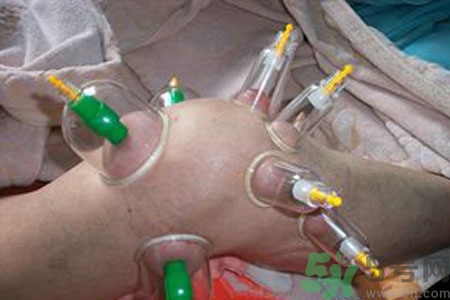 膝蓋能拔罐嗎？膝蓋疼可以拔罐嗎？