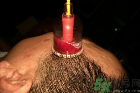 太陽(yáng)穴可以拔火罐嗎？偏頭疼可以在太陽(yáng)穴拔火罐嗎？