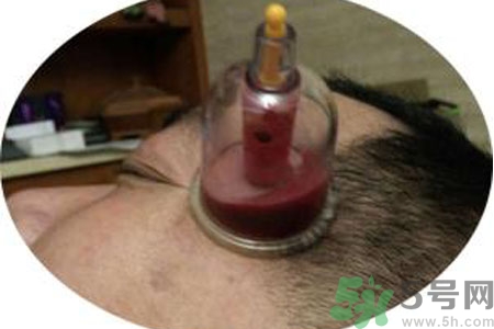 太陽(yáng)穴可以拔火罐嗎？偏頭疼可以在太陽(yáng)穴拔火罐嗎？