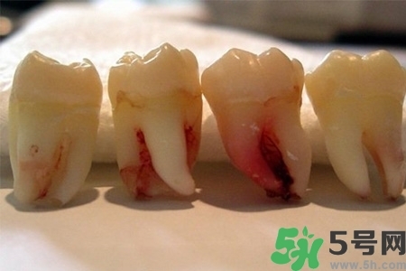 智齒長歪了一定要拔嗎？智齒長歪了必須拔嗎？