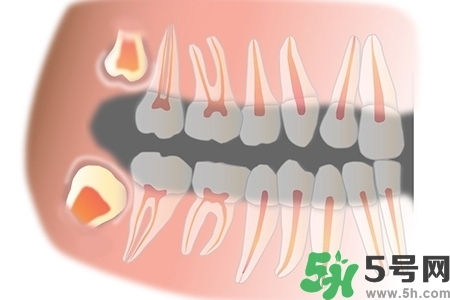 智齒長歪了一定要拔嗎？智齒長歪了必須拔嗎？