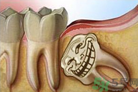 智齒長歪了一定要拔嗎？智齒長歪了必須拔嗎？