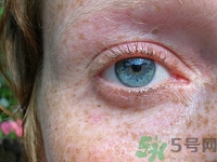 孕婦長(zhǎng)斑怎么辦?孕婦長(zhǎng)斑怎么治療最有效 孕婦長(zhǎng)斑怎么辦?孕婦長(zhǎng)斑怎么治療最有效