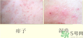 濕疹和痱子一樣嗎？濕疹和痱子有甚么區(qū)別？