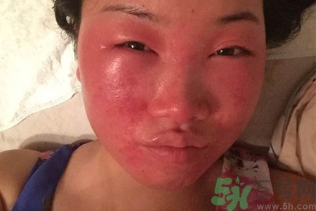 臉過敏發(fā)紅癢怎么辦？臉過敏發(fā)紅癢擦什么藥好？