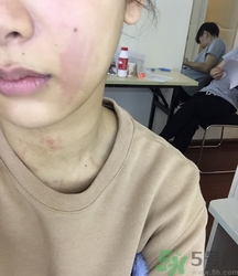 蕁麻疹是怎么引起的?蕁麻疹有什么癥狀 蕁麻疹是怎么引起的?蕁麻疹有什么癥狀