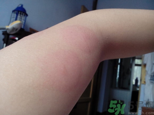 蕁麻疹是怎么引起的?蕁麻疹有什么癥狀 蕁麻疹是怎么引起的?蕁麻疹有什么癥狀