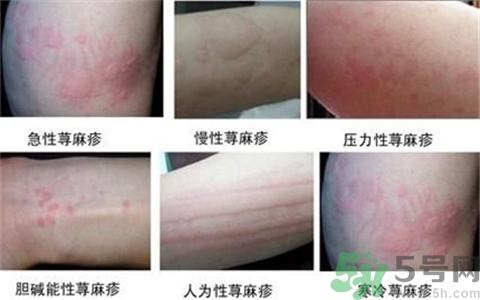 蕁麻疹有幾種類型?蕁麻疹類型對照圖 蕁麻疹有幾種類型?蕁麻疹類型對照圖