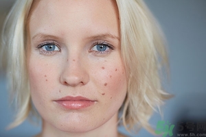 蕁麻疹有幾種類型?蕁麻疹類型對照圖 蕁麻疹有幾種類型?蕁麻疹類型對照圖