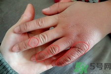 生凍瘡吃什么食物最好？預(yù)防凍瘡吃什么最有效？