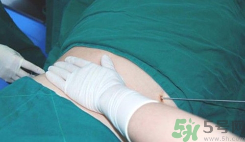 抽脂后會不會反彈?抽脂反彈了怎么辦 抽脂后會不會反彈?抽脂反彈了怎么辦