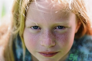 激光祛斑能洗臉嗎?激光祛斑后如何保養(yǎng)?