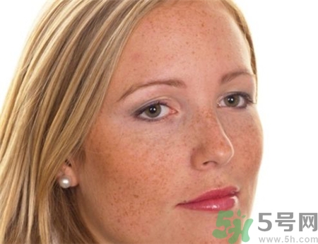 激光祛斑后反黑怎么辦?激光祛斑后反黑多久能恢復(fù)? 激光祛斑后反黑怎么辦?激光祛斑后反黑多久能恢復(fù)?