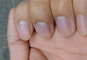 ?指甲上有豎紋是缺什么？指甲上有豎紋是缺維生素嗎？