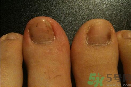 腳趾甲變黑是什么原因？腳趾甲變黑是怎么回事？