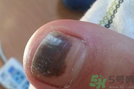 腳趾甲變黑是什么原因？腳趾甲變黑是怎么回事？